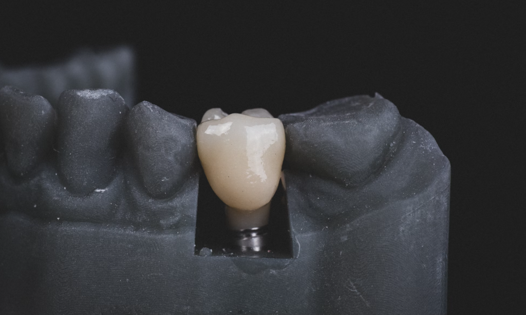 Do Dental Crowns Stain and Darken? Family Tree Dental